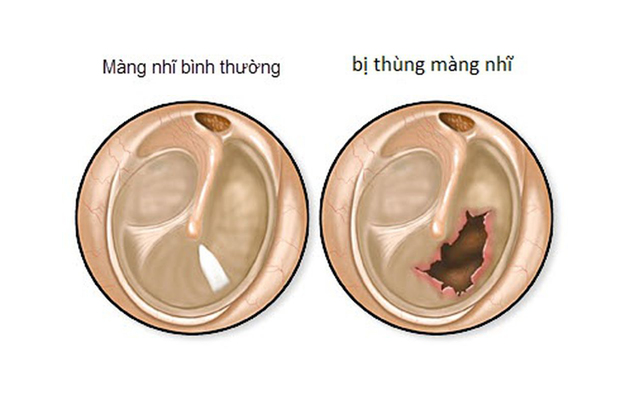 Thủng màng nhĩ, nguyên nhân do đâu?