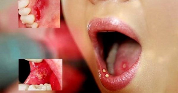 Cách trị lở miệng khi trở nặng