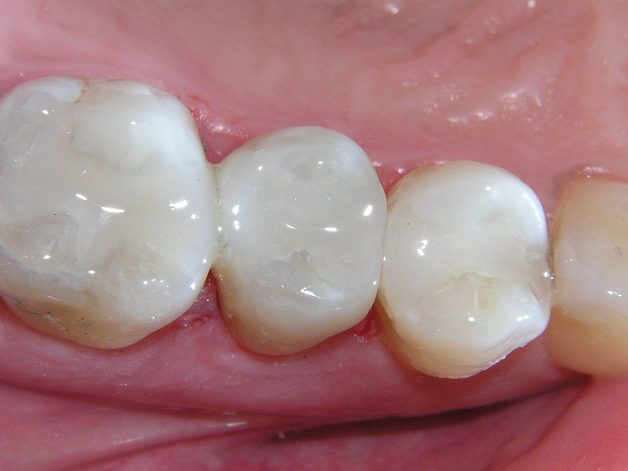 Trám răng Composite là một trong những phương pháp được ưa chuộng nhất hiện nay, được áp dụng tại các cơ sở nha khoa uy tín