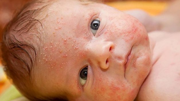 các nhà nghiên cứu đã chỉ ra có khoảng 70% sau sinh da trẻ có mụn trứng cá nhỏ màu đỏ