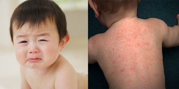 trẻ bị nổi mẩn ngứa