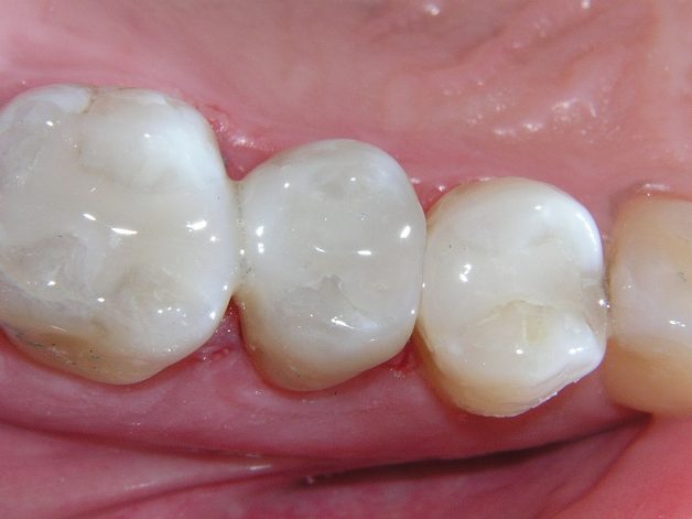 Vật liệu composite có màu sắc trắng, tự nhiên, gần như tương đồng với màu răng thật.