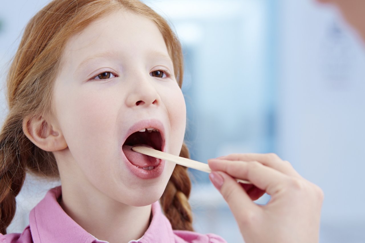 Viêm amidan là tình trạng virus và vi khuẩn gây bệnh tấn công vào họng làm cho amidan sưng đỏ, viêm nhiễm