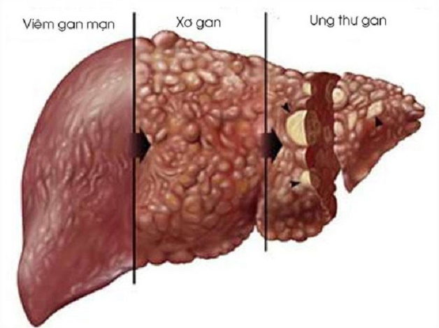 Biến chứng của viêm gan C mạn tính