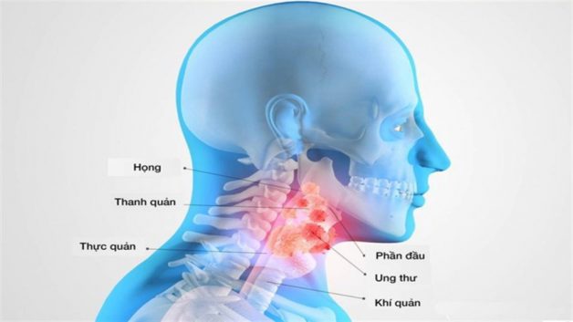 Viêm họng nổi hạch nên làm gì để hết triệu chứng