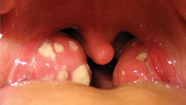 viêm họng nổi hạch