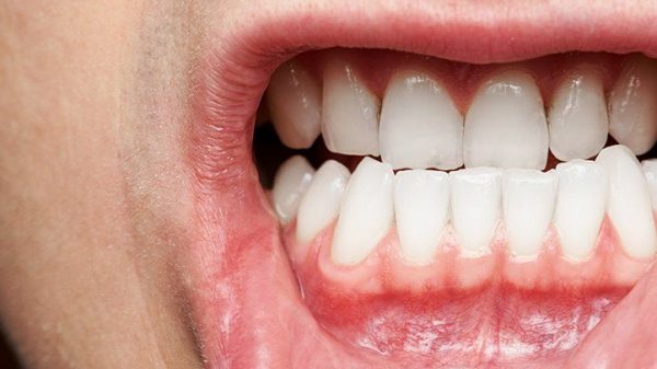 viêm lợi là nguyên nhân khiến răng nhạy cảm