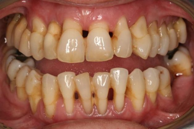 Viêm nha chu khiến răng yếu, tụt lợi và tiêu xương nên khó áp dụng phương pháp nẹp răng