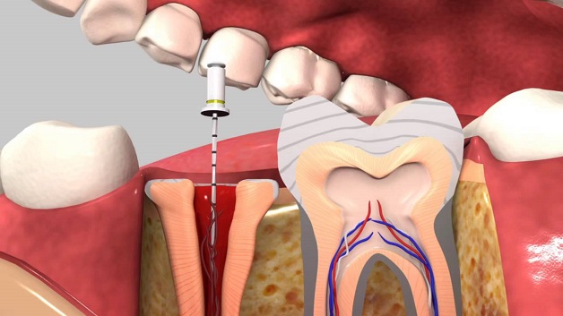Với bệnh nhân bị viêm quanh cuống răng thì được tiến hành hồi phục cuống răng bằng việc loại bỏ vi khuẩn gây bệnh và phần hoại tử