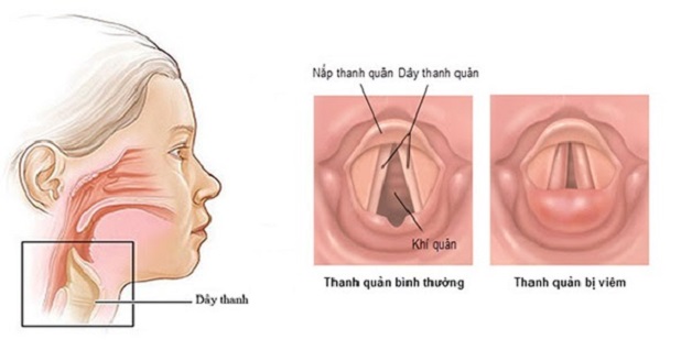 Viêm thanh quản là tình trạng tổn thương ở thanh quản, dây thanh âm trong cổ họng bị kích thích, sưng đỏ do sử dụng quá mức hoặc vi khuẩn tấn công gây nhiễm trùng.