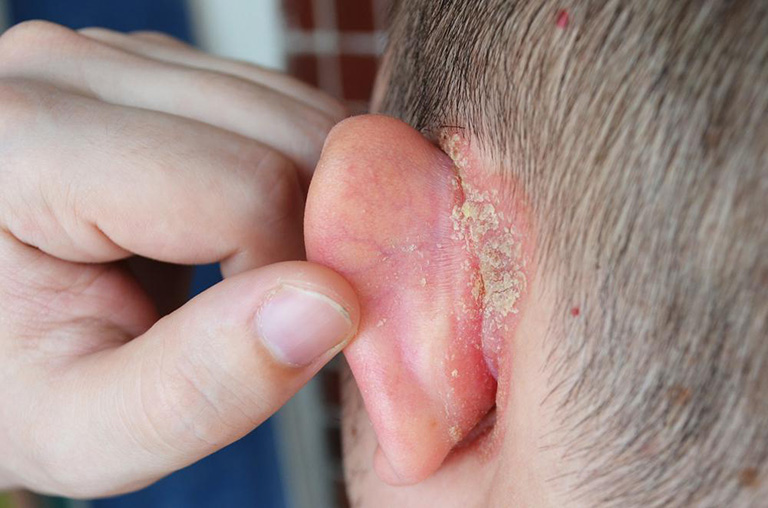 Vệ sinh tai không đúng cách có thể gây viêm vành tai