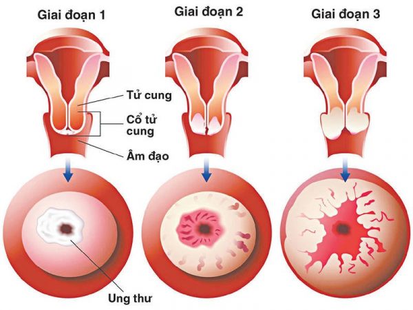 Tổng quan về xét nghiệm tầm soát ung thư cổ tử cung