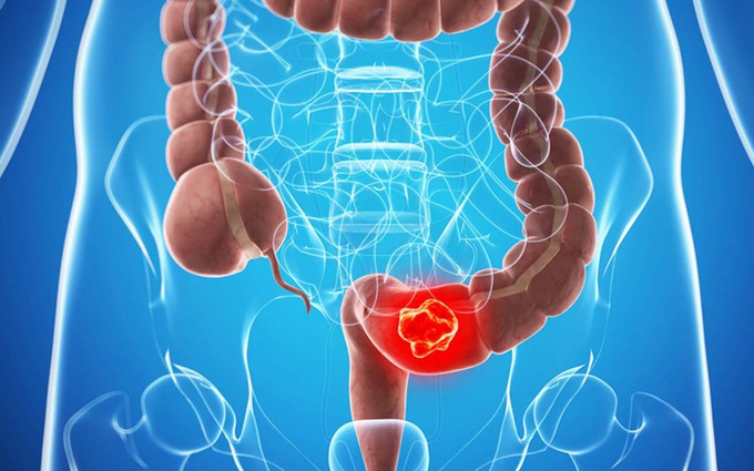 Tầm quan trọng của xét nghiệm phát hiện sớm ung thư tiêu hóa