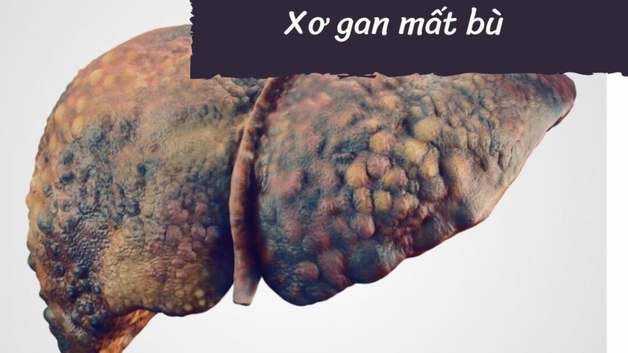 xơ gan mất bù sống được bao lâu