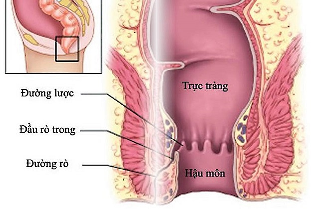 Cách xử lý rò hậu môn hiệu quả