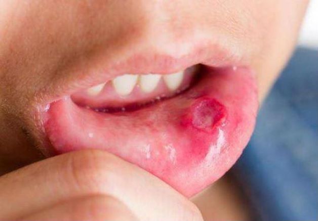 Có cách điều trị nhiệt miệng nào?