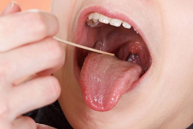 Viêm họng thể cấp tính điều trị như thế nào?