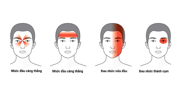 Một số vị trí đau đầu thường gặp hiện nay ở người bệnh.