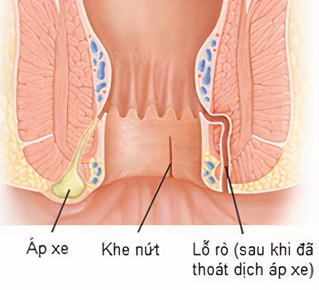 Biến chứng của apxe hậu môn có thể gây ra rò hậu môn phức tạp