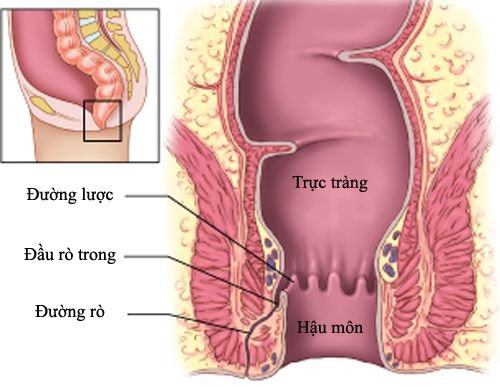 Bệnh rò ở hậu môn là giai đoạn sau của áp xe hậu môn