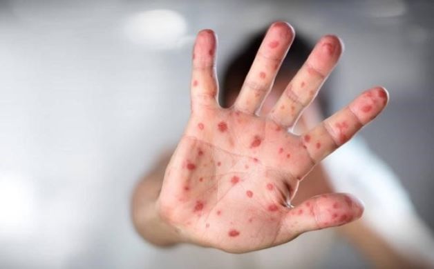 Giai đoạn toàn phát bệnh, các mụn nước dần xuất hiện ở tay, chân. trong khoang miệng... của trẻ.