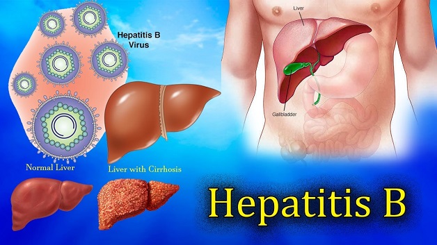 Với những nguy cơ tiềm ẩn, bệnh viêm gan B được mệnh danh là “sát nhân thầm lặng”