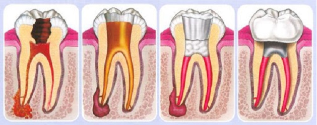 Viêm tủy, tủy hoại tử là một trong những nguyên nhân gây viêm quanh cuống răng