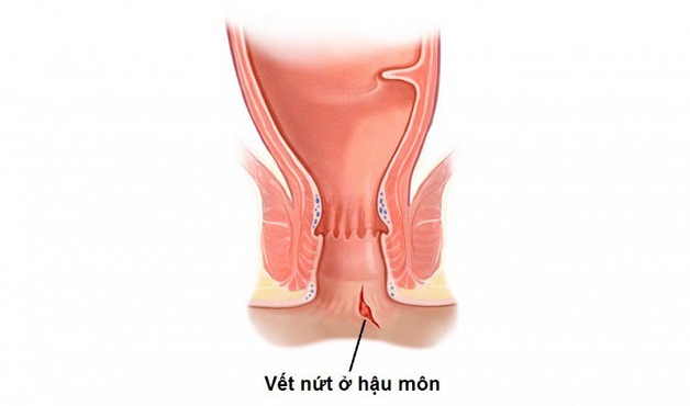 Bị nứt kẽ hậu môn phải làm sao để ngăn chặn các biến chứng nguy hiểm xảy ra