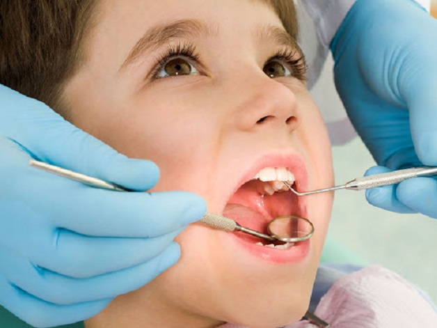 Điều trị tủy là cách chữa sâu răng cho trẻ 2 tuổi khi các vết sâu đã lan rộng đến khu vực tủy răng