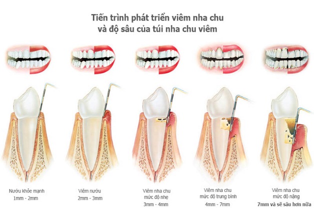 Quá trình phát triển của bệnh viêm nha chu