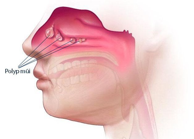 khám viêm xoang cánh bướm