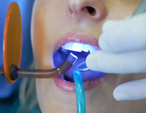 Chiếu đèn quang trùng hợp với từng lớp Composite, thời gian khoảng 20 - 40 giây.