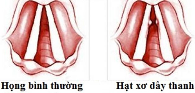 Những nguyên nhân gây khàn tiếng kéo dài