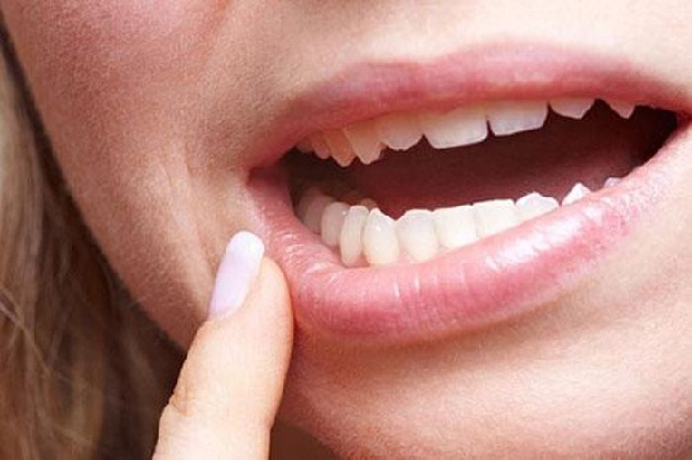 Có nhiều nguyên nhân gây ra viêm niêm mạc miệng