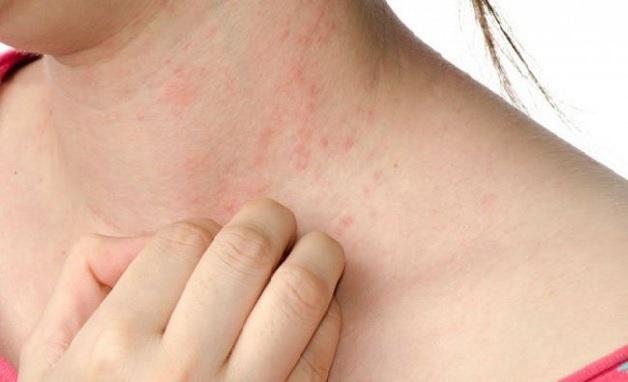 trẻ bị sốt phát ban ngứa