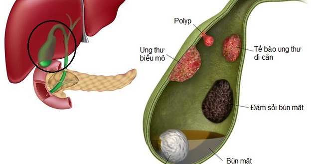 Tìm hiểu có polyp ở túi mật là gì