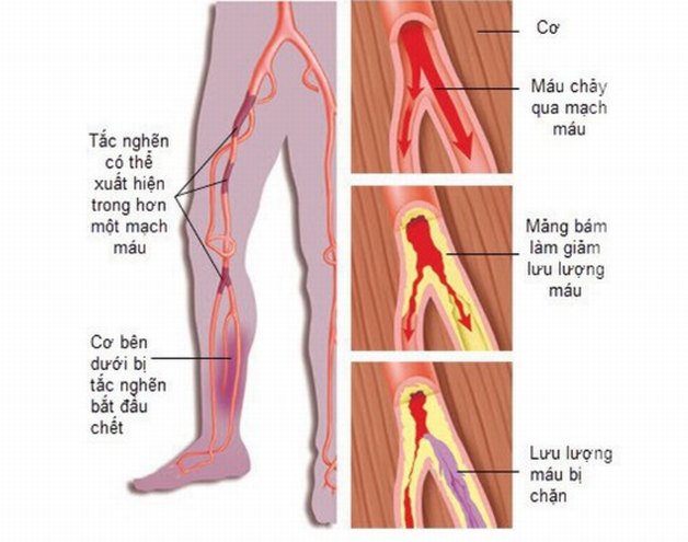 dấu hiệu của xơ vữa động mạch vùng chi dưới