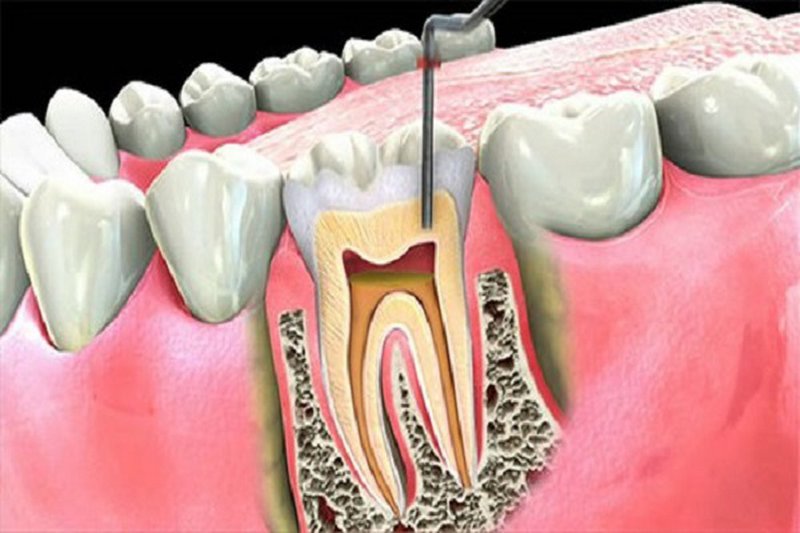 Diệt tủy răng có ảnh hưởng gì không là điều mà nhiều mà nhiều người