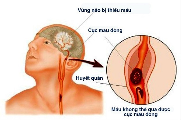 Đột quỵ dạng nhồi máu não là tình trạng máu không thể lưu thông do có cục máu đông chèn ép động mạch