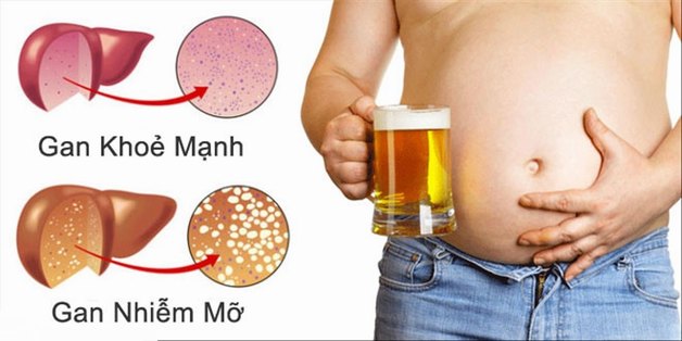 gan nhiễm mỡ là gì