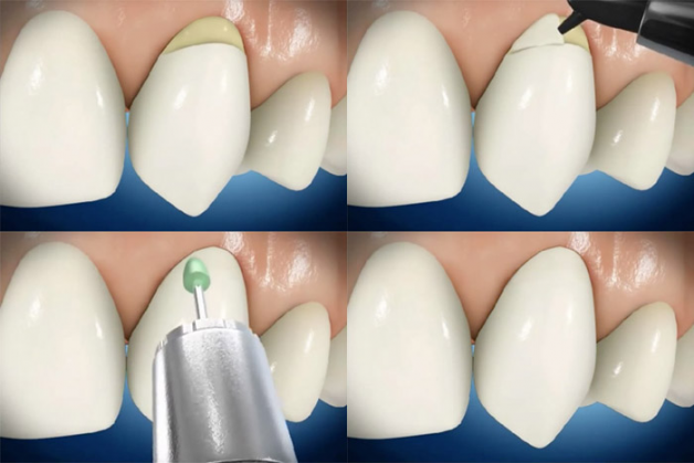phục hồi cổ răng bằng Composite