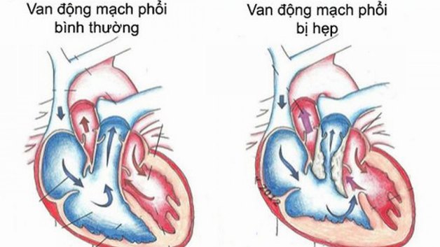 hẹp van động mạch phổi là gì?