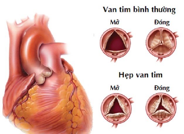 Hẹp van tim nguyên nhân bẩm sinh là hiện tượng van tim không thể mở hoàn toàn do các khiếm khuyết trong quá trình hình thành bào thai