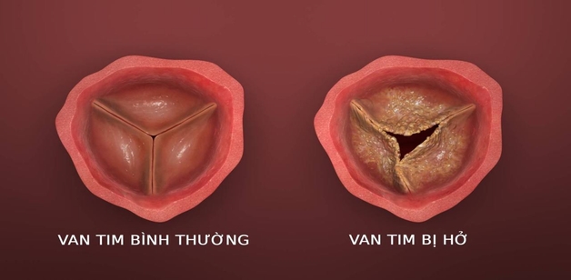hở van động mạch chủ 1/4 là gì