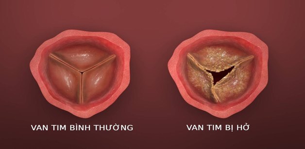 hở van tim 1/4 là gì