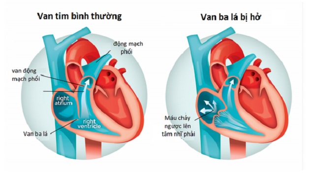 Hở van tim 3 lá 2/4 là gì?