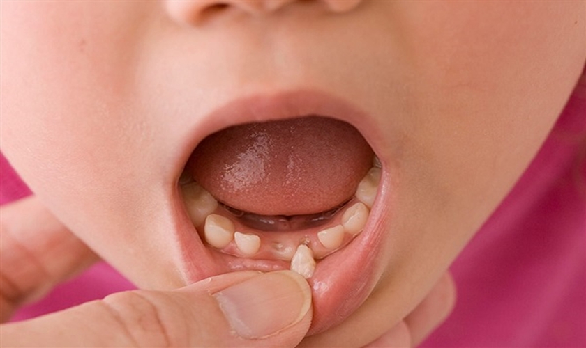 Răng sữa có thể tự nhổ tại nhà cho trẻ