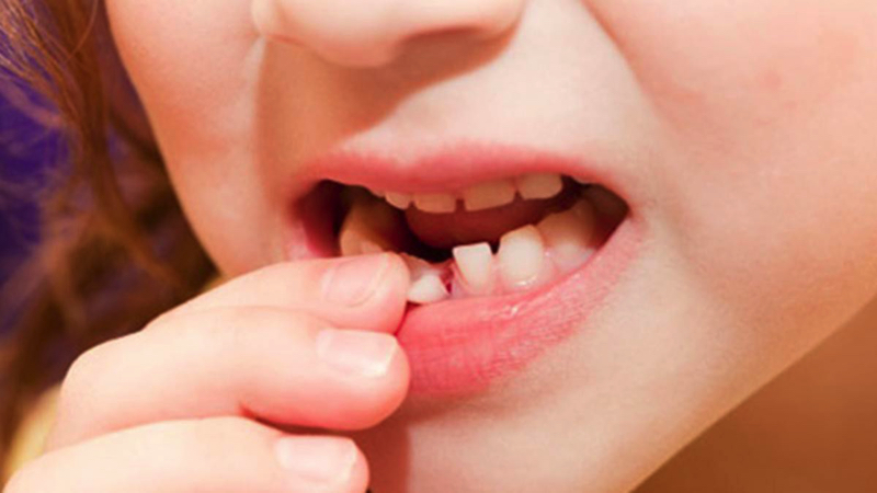 Khi nào cần nhổ răng sữa cho bé?