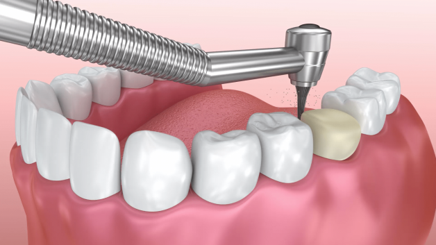 Để có thể gắn được mão răng lên, bác sĩ sẽ tiến hành mài cùi răng thật của bệnh nhân