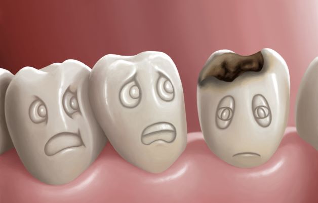Sâu răng được coi là một trong những nguyên nhân hàng đầu khiến trẻ bị những cơn đau răng “hành hạ”.